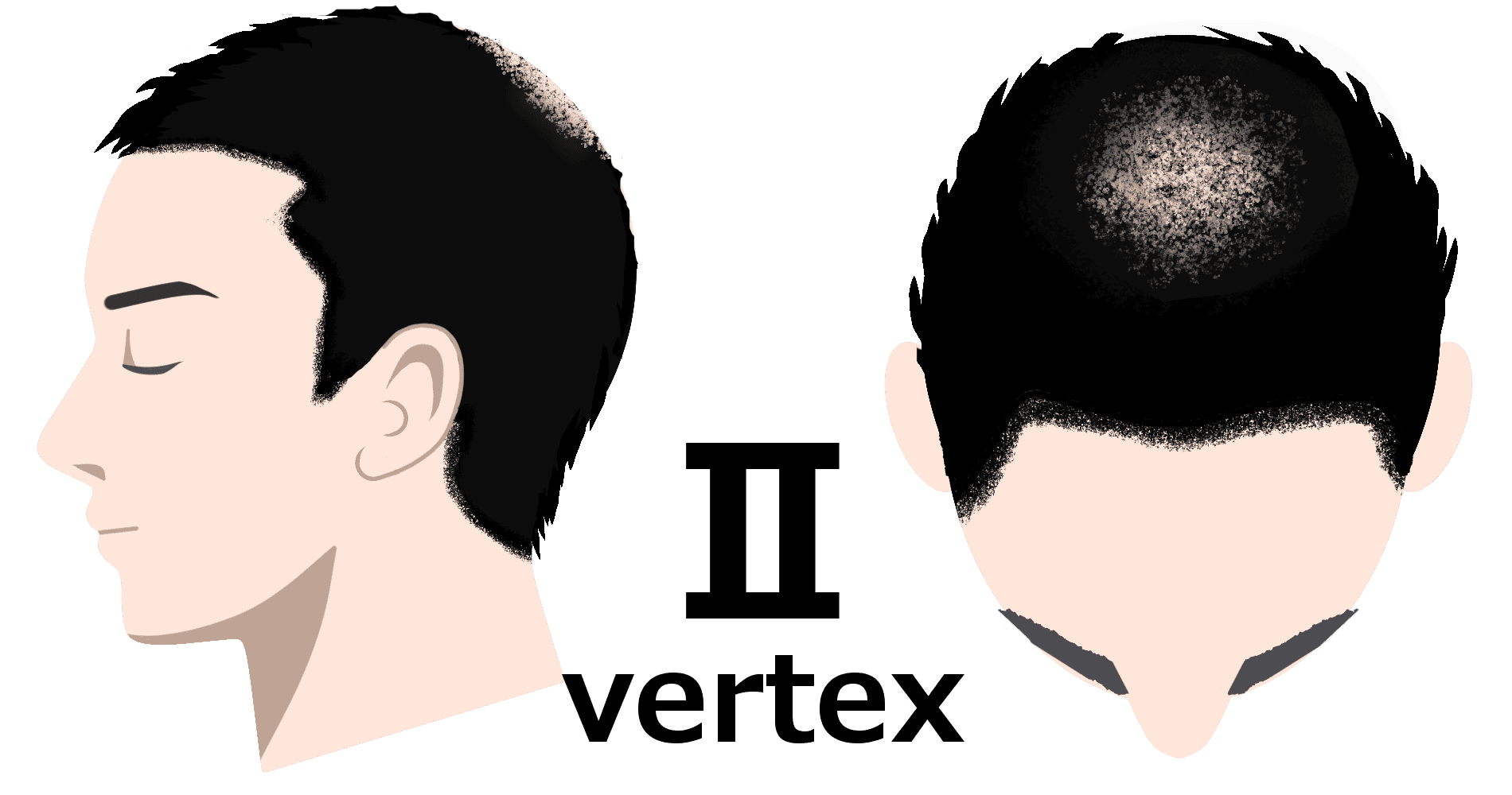 Ⅱvertex（ハミルトンノーウッド分類）