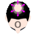 O字型のうす毛進行