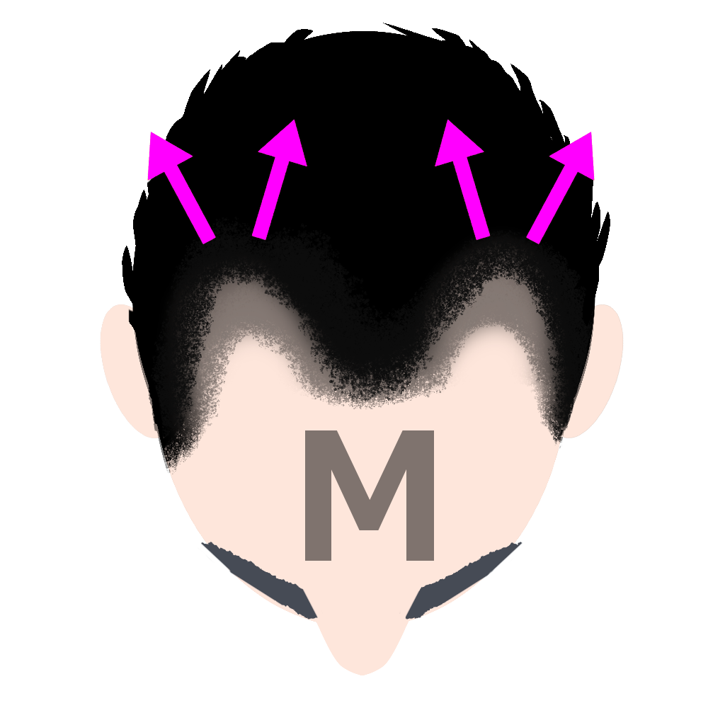 M字型のうす毛進行